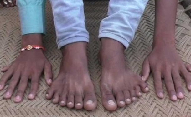 В Индии шестипалого мальчика хотят принести в жертву