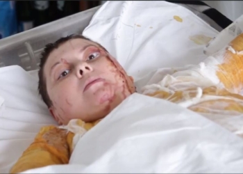 Видеообращение облитой кислотой Катерины Гандзюк: Я выгляжу плохо, но правосудие и справедливость в Украине выглядят еще хуже