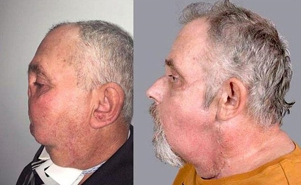 Сто врачей за 30 часов пришили канадскому охотнику новое лицо