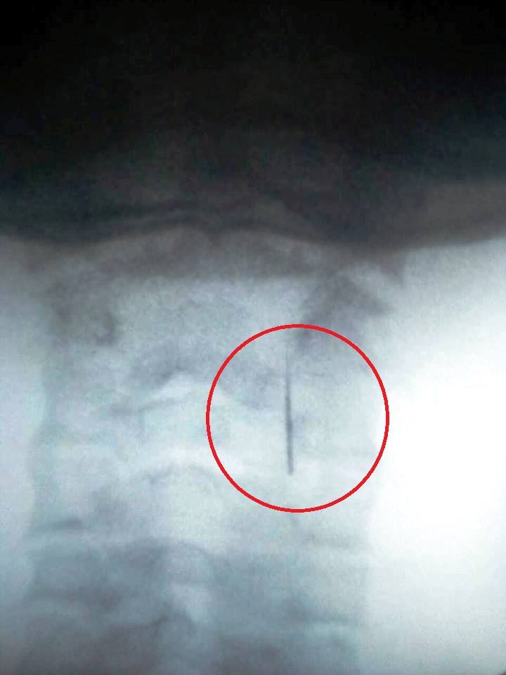 УЖАС. Стоматолог потерял иглу в горле ребенка, мать 2 дня гоняли по городам и больницам 3