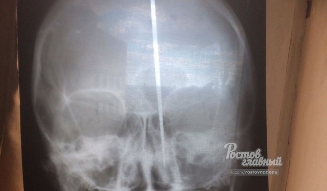 “Голова хотела дышать”: в России мужчина воткнул себе в голову нож и выжил (18+)