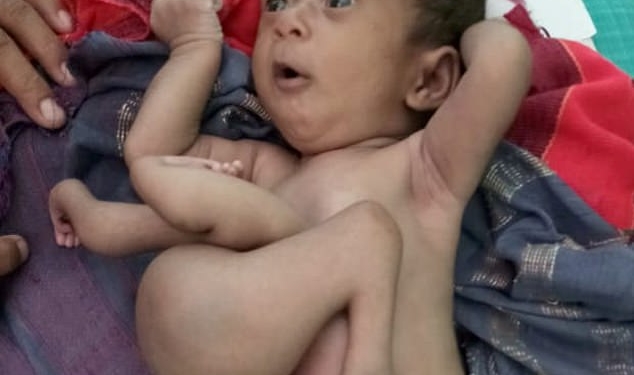 В Индии спасли ребенка, родившегося с паразитическим близнецом в теле