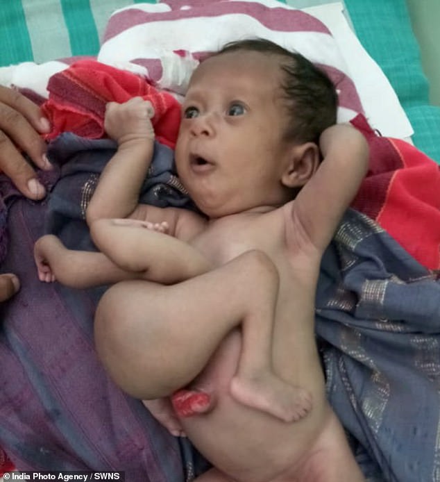 В Индии спасли ребенка, родившегося с паразитическим близнецом в теле 3