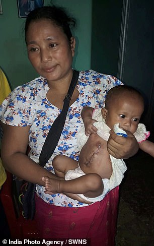 В Индии спасли ребенка, родившегося с паразитическим близнецом в теле 5