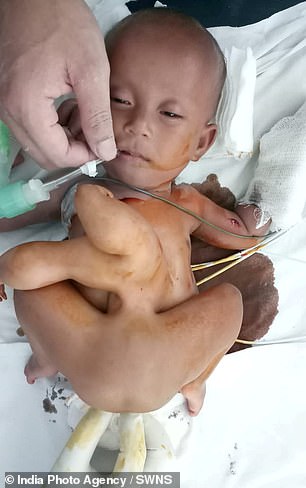 В Индии спасли ребенка, родившегося с паразитическим близнецом в теле 7