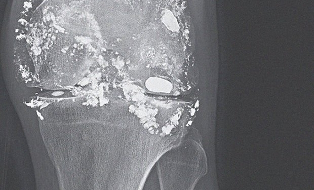 Мужчина 14 лет ходил с пулей в колене, которая превратилась в свинец