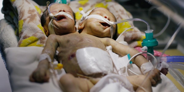 В Йемене родились уникальные двухголовые сиамские близнецы