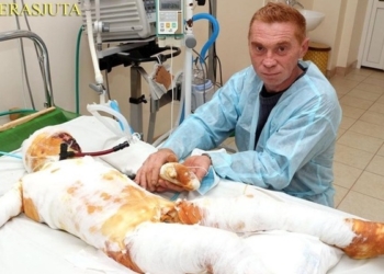 На Николаевщине родители бросили в больнице обожженого сына, который чудом выжил после удара током