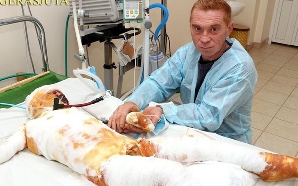 На Николаевщине родители бросили в больнице обожженого сына, который чудом выжил после удара током