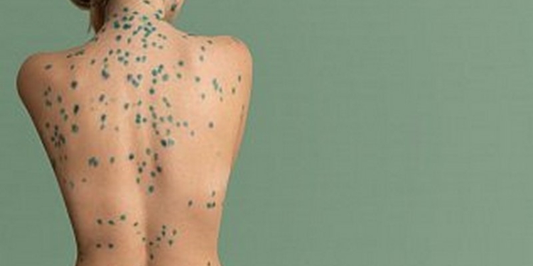 Россиянку с детьми на Канарских островах сняли с самолета из-за ветрянки