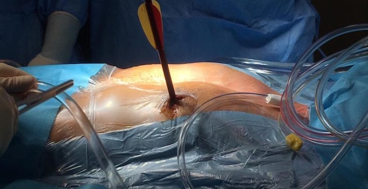 В Италии кардиохирурги спасли мужчину, которому в сердце попала 30-сантиметровая арбалетная стрела (ФОТО)