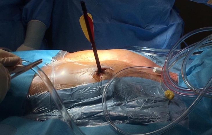 В Италии кардиохирурги спасли мужчину, которому в сердце попала 30-сантиметровая арбалетная стрела (ФОТО) 5
