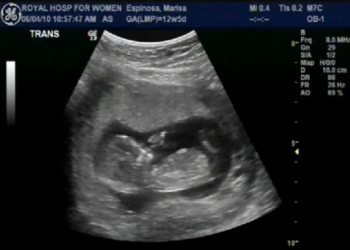 Выбирать пол будущего ребенка скоро можно будет без участия врачей. Ученые считают, что это плохая идея