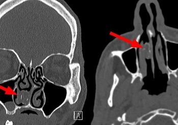 Австралиец 18 лет жил с капсулой марихуаны в носу