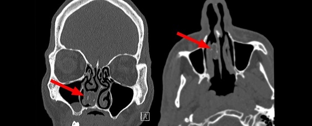 Австралиец 18 лет жил с капсулой марихуаны в носу