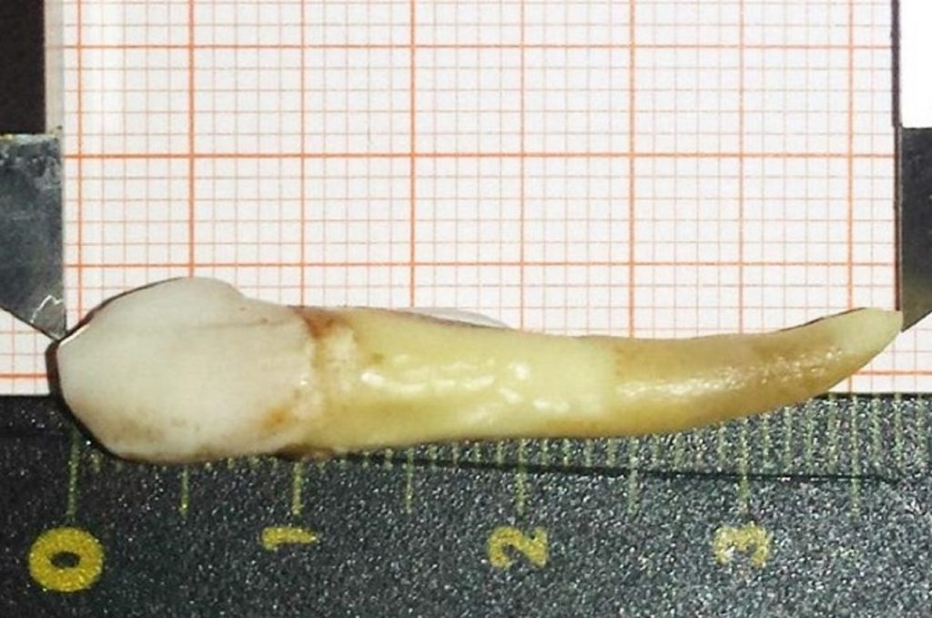 Как у вампира. Стоматологу пришлось удалять клык длиной почти в 4 см (ФОТО) 3