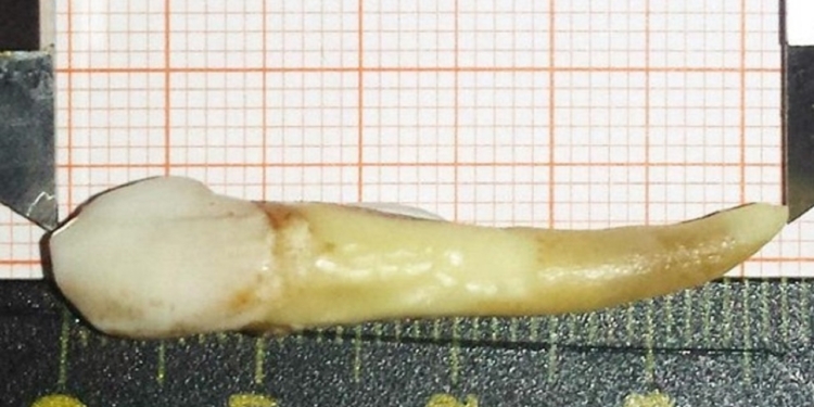 Как у вампира. Стоматологу пришлось удалять клык длиной почти в 4 см (ФОТО)