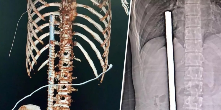 В Китае врачи спасли строителя, которой нанизал себя на железный прут (ФОТО)