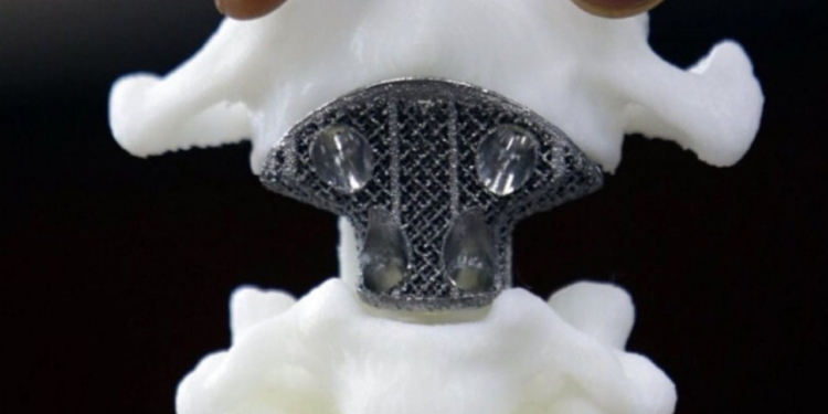 Одесситы печатают искусственные кости и вживляют их