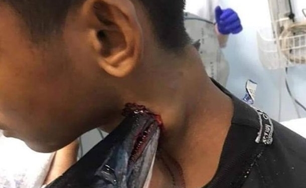 В Индонезии рыба-игла выпрыгнула из воды и пробила насквозь шею рыбаку-мальчишке (ФОТО)