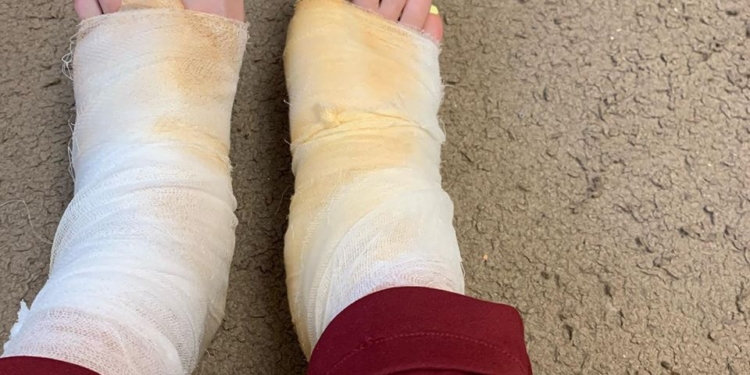 В Николаеве женщина обещает подать в суд на косметический салон из-за ожогов после педикюра (ФОТО)