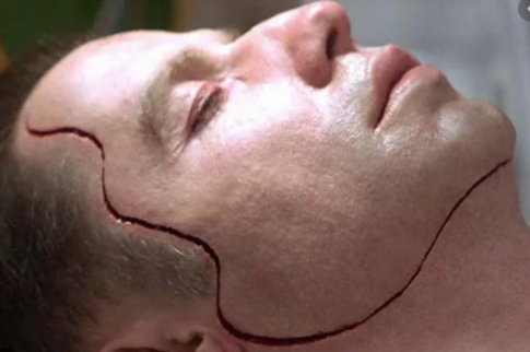 Американские врачи впервые в истории успешно пересадили лицо и руки человеку (ВИДЕО)