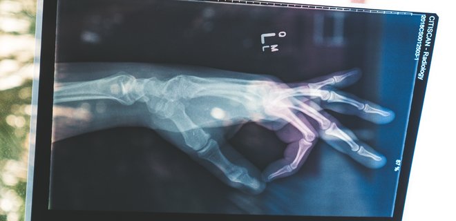 Ученые утверждают, что теперь «печатать» кости можно прямо в человеке (ВИДЕО)