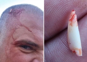 Акула сломала зуб об голову мужчины, пытаясь укусить его