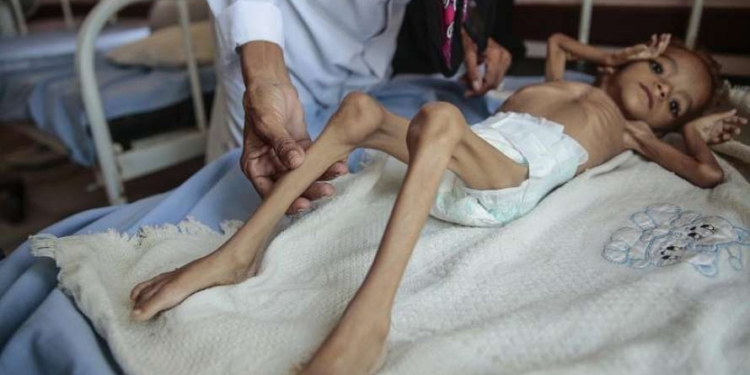 Количество голодающих в мире достигло пятилетнего максимума – ООН