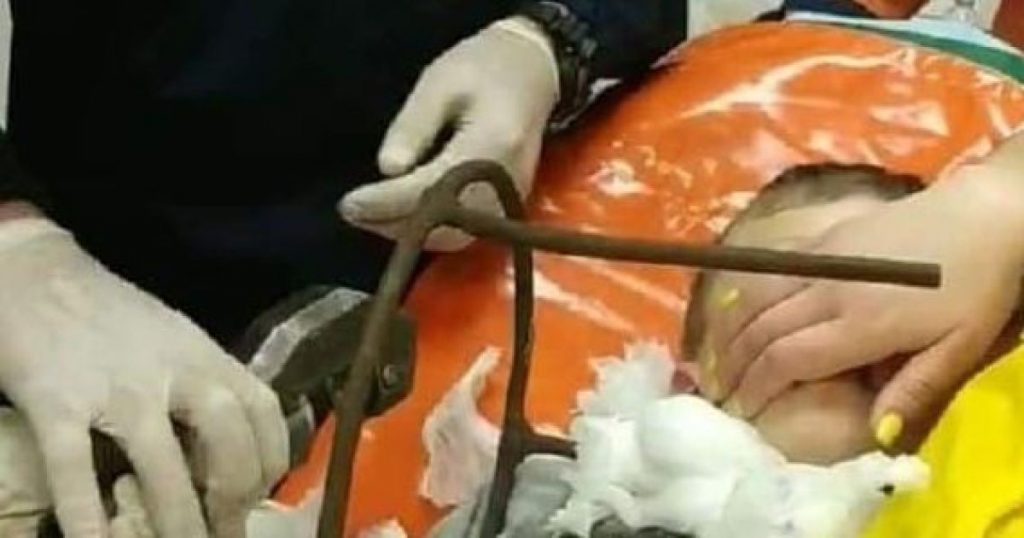 В Полтаве 6-летнему мальчику металлический штырь пробил шею насквозь. Врачи спасли жизнь ребенка 1