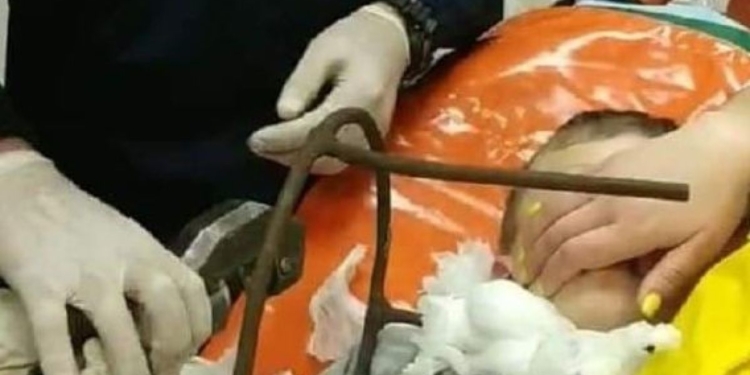 В Полтаве 6-летнему мальчику металлический штырь пробил шею насквозь. Врачи спасли жизнь ребенка