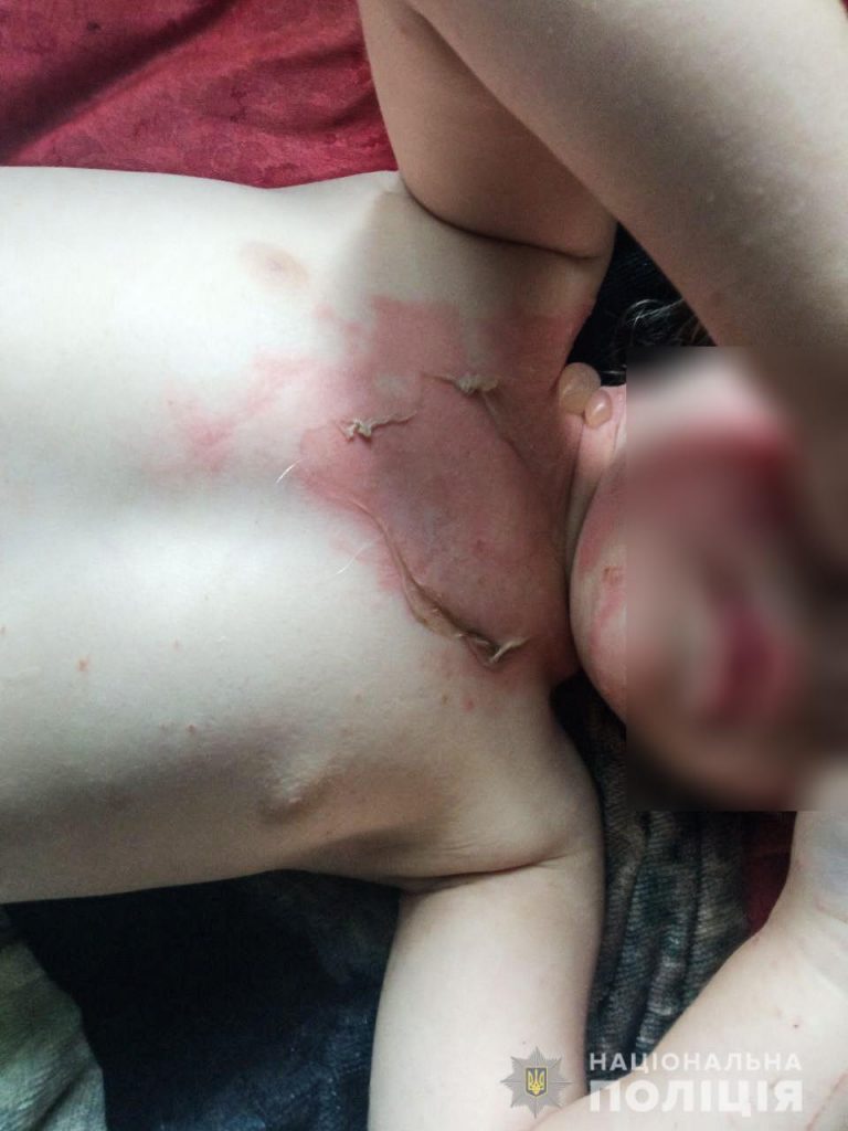 На Николаевщине 2-летняя девочка опрокинула на себя кружку с кипятком. Скорую ей вызвал полицейский (ФОТО) 1