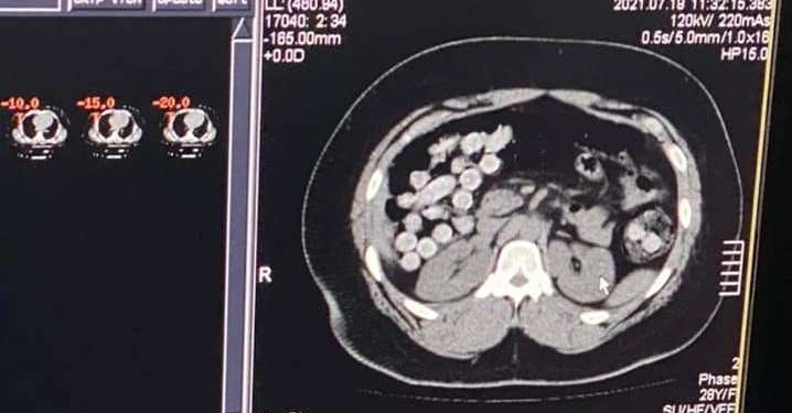 Иностранец проглотил 1 кг кокаина. Но это не помогло ему провезти наркотики из Латинской Америки в Украину (ФОТО)