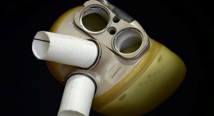 Человеку впервые пересадили искусственный “мотор” – французское сердце получил итальянец