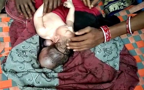 В Индии родился ребенок с тремя головами, его сочли воплощением бога 1