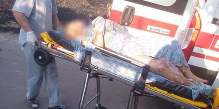 Сжигала мусор, вспыхнул сухостой, – на Николаевщине доставили в больницу женщину с тяжелыми ожогами