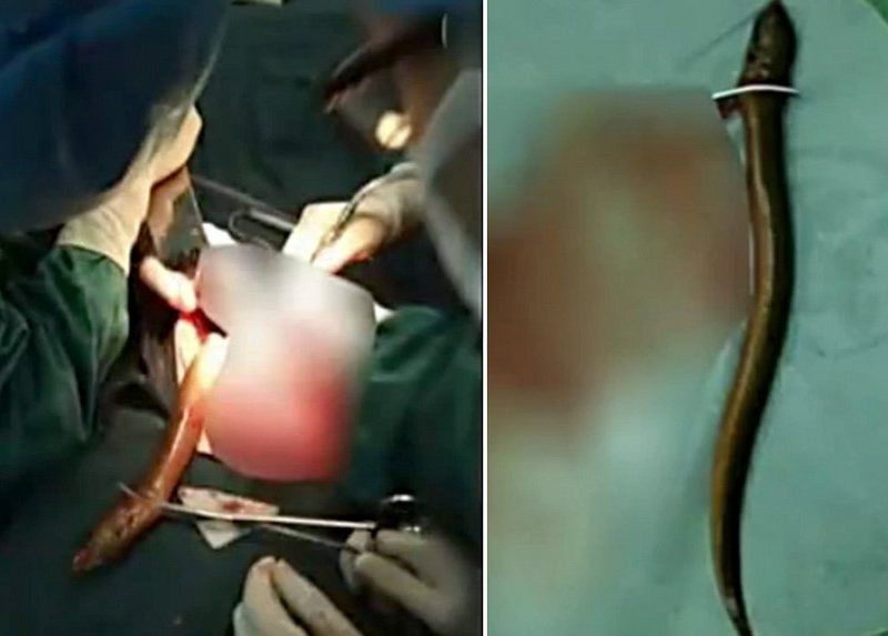 Китаец ввел в прямую кишку живого угря: народный способ лечения запора привел его на операционный стол