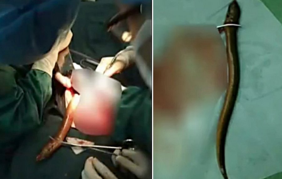 Китаец ввел в прямую кишку живого угря: народный способ лечения запора привел его на операционный стол 1