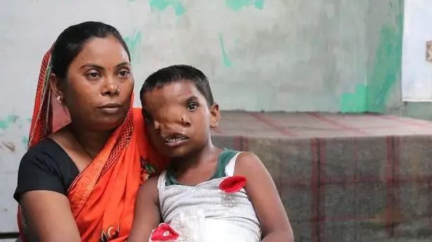 В Индии девочку с “хоботом” признали воплощением божества