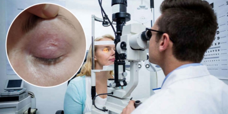 После укуса отечественного комара. Из века украинки достали 9-сантиметрового паразита (ФОТО, ВИДЕО)