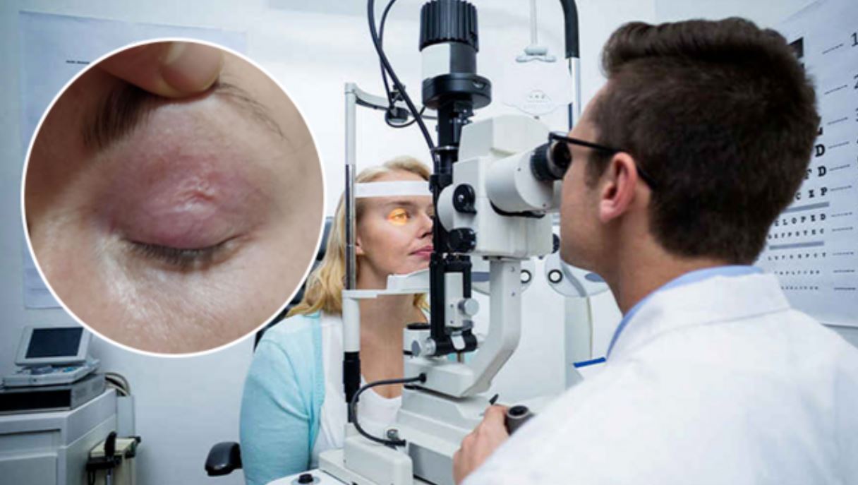 После укуса отечественного комара. Из века украинки достали 9-сантиметрового паразита (ФОТО, ВИДЕО)