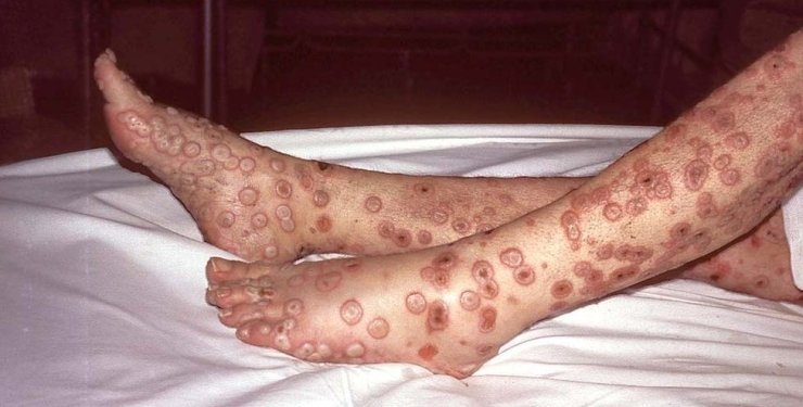 ВОЗ созывает чрезвычайную встречу из-за обезьяньей оспы