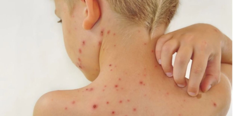 В Черновцах заболели ветрянкой 20 детей из Николаевского дома ребенка