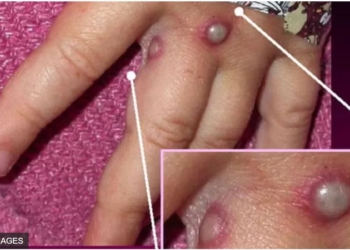 В світі зафіксовано 2 смерті від мавпячої віспи