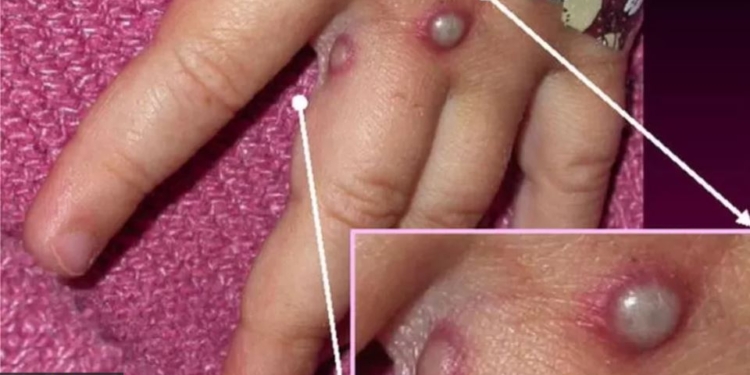 В світі зафіксовано 2 смерті від мавпячої віспи