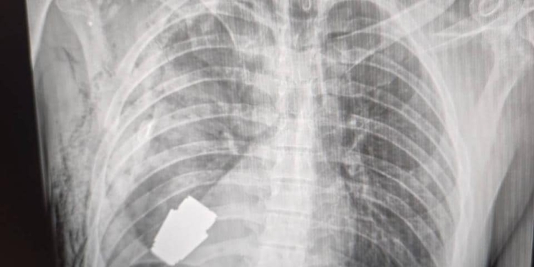 Операція в присутності саперів: військові лікарі видалили з області серця військового гранату ВОГ, яка не розірвалась (ФОТО)