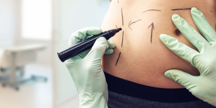 Міжнародне товариство пластичної хірургії назвало найпопулярнішу операцію – і це вже не збільшення грудей