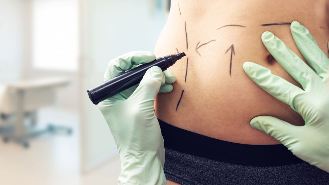 Міжнародне товариство пластичної хірургії назвало найпопулярнішу операцію – і це вже не збільшення грудей