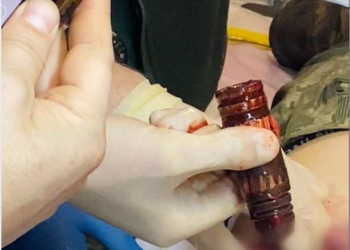 З тіла пораненого бійця ЗСУ військові хірурги дістали гранату (ФОТО)