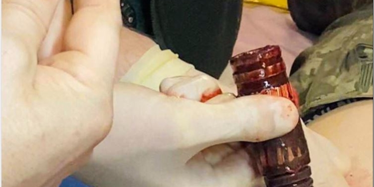 З тіла пораненого бійця ЗСУ військові хірурги дістали гранату (ФОТО)